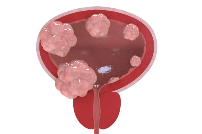 neoplasie vescica